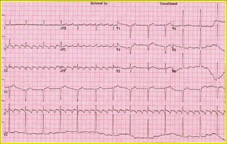 ekg hera